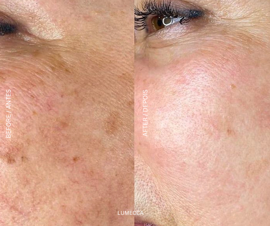 Lumecca IPL laser treatment device at AD Lisbon